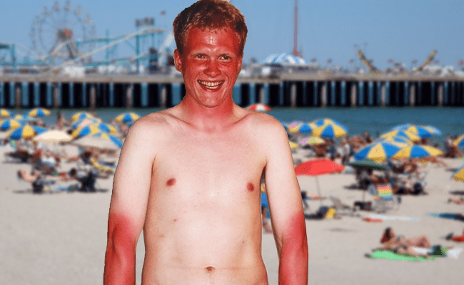 sunburnt.png