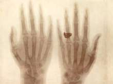 X-ray image of baroness Josephina Mollinary-Vranyczany's hands (1896)